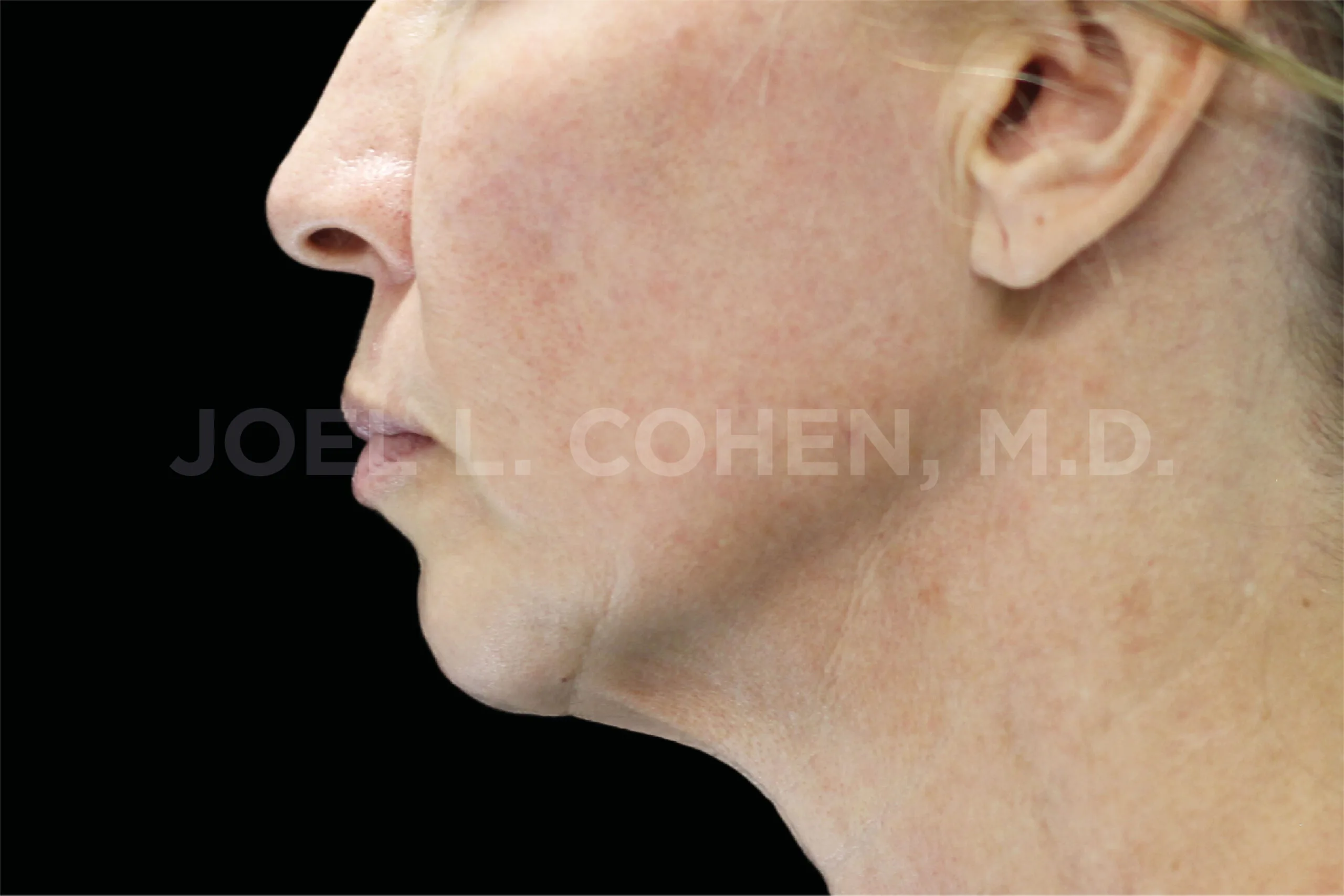 EMface facial toning London - after photo of the jawline and neck in profile Jawline and neck in profile after EMface facial toning at our London clinic