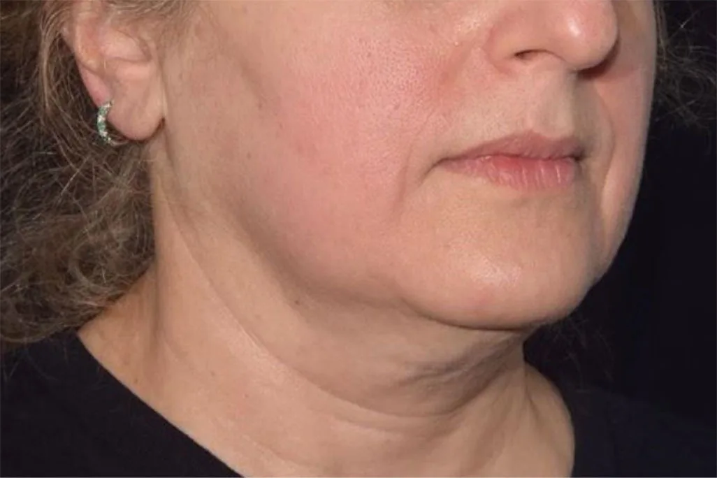 EMface facial toning London - after photo of the jawline and neck Jawline and neck after EMface facial toning at our London clinic