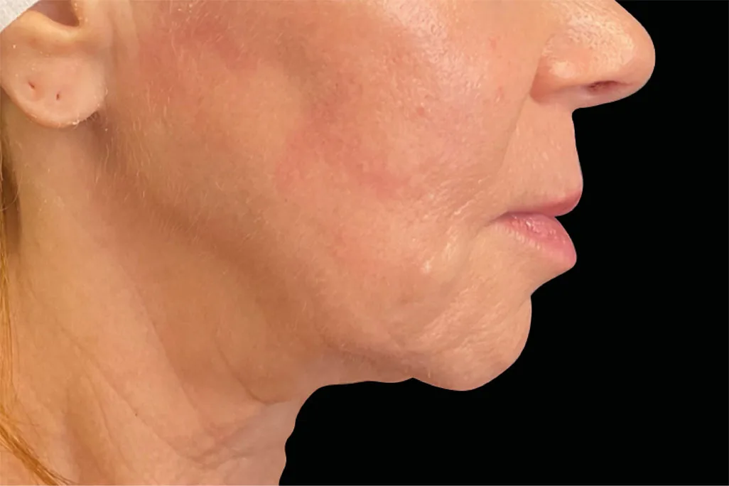 EMface facial toning London - after photo of the neck in profile Neck in profile after EMface facial toning at our London clinic