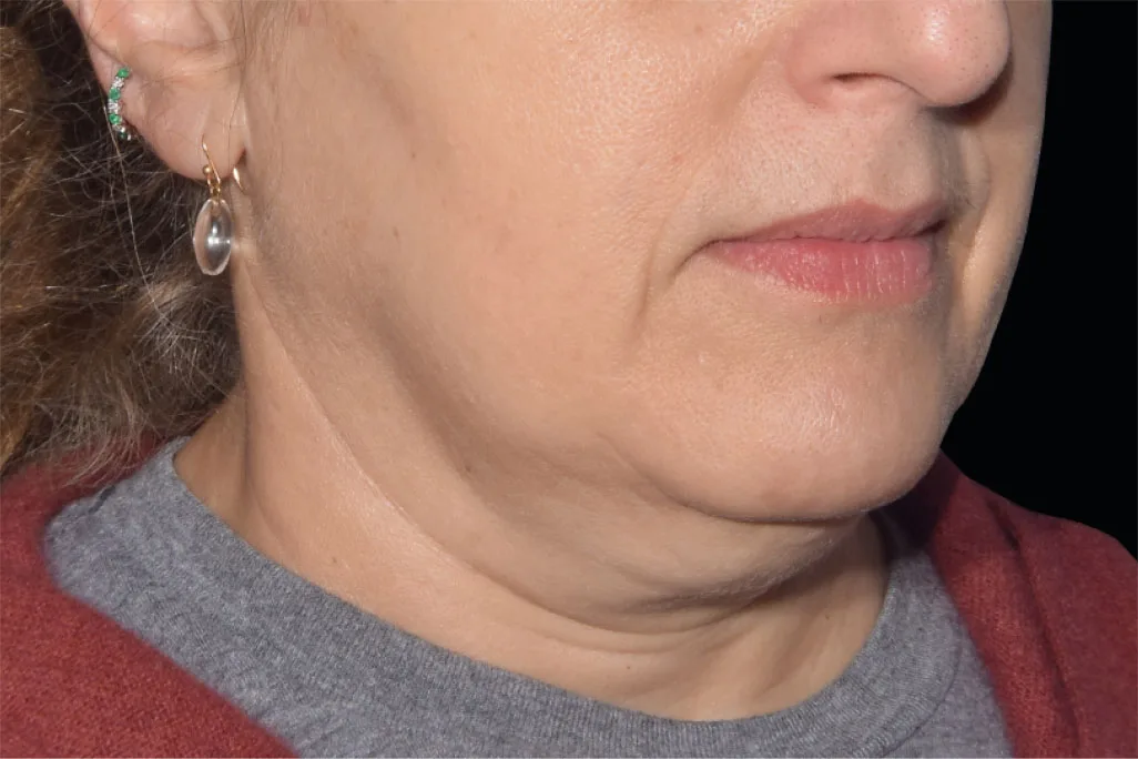 EMface facial toning London - before photo of the jawline and neck Jawline and neck before EMface facial toning at our London clinic